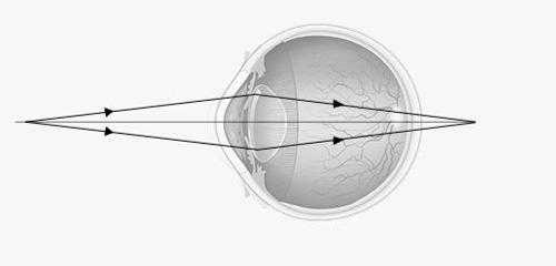 presbyopia