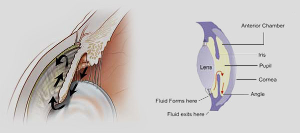 Trattamento della stella verde - glaucoma SLT 